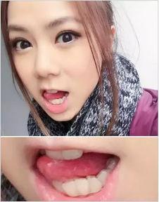 牙齿歪明星,牙齿歪矫正之旅